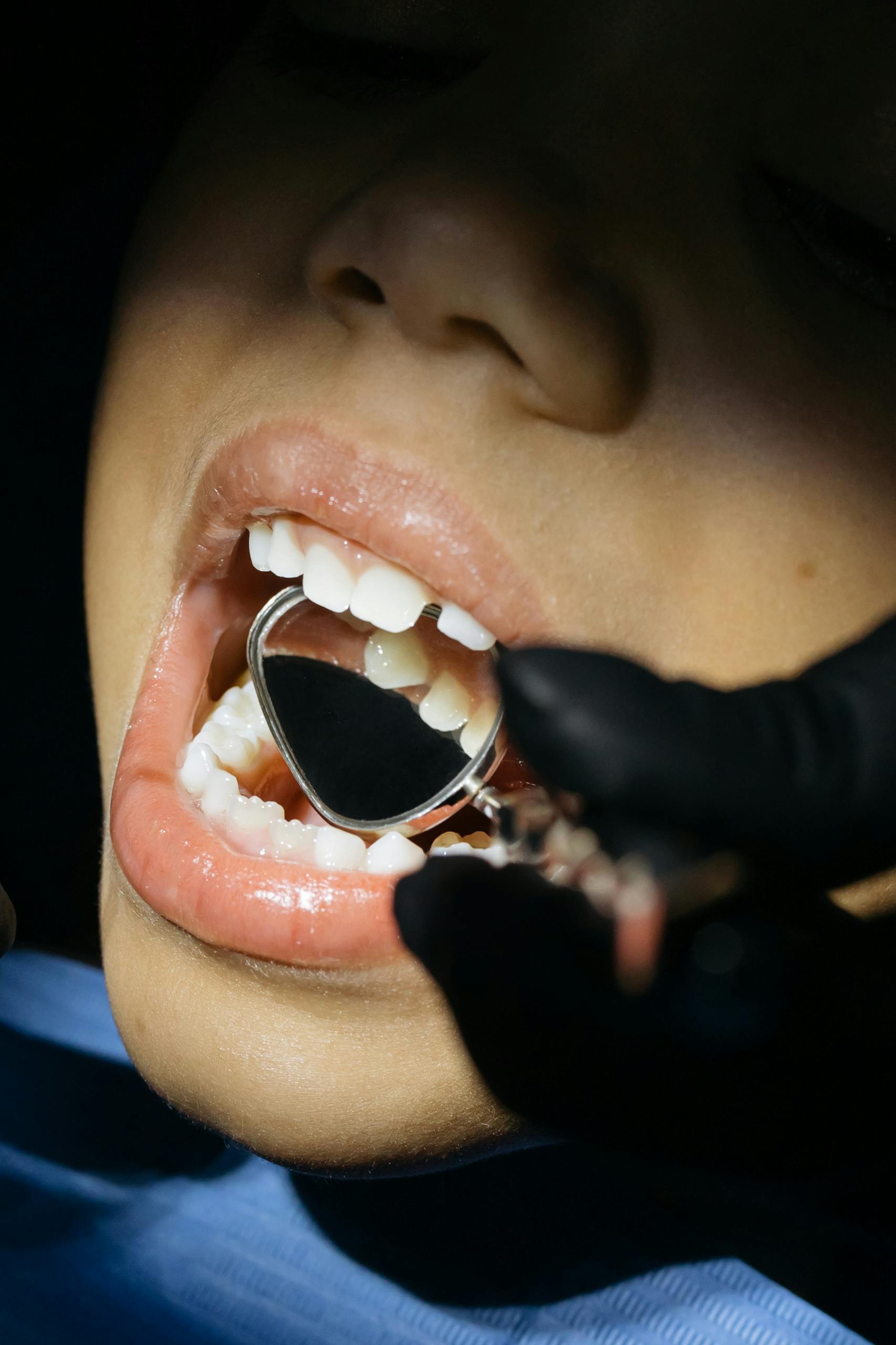 Close-up of a child's mouth during a dental examination with a mouth mirror.